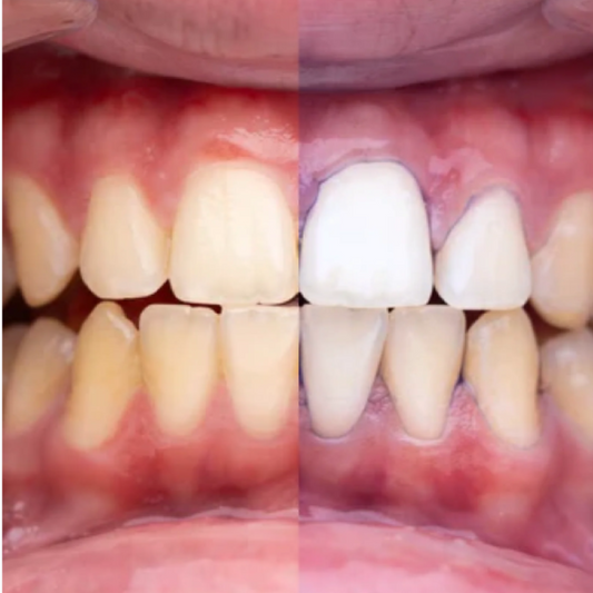 GlumiWhite™ – V34 Bělení – [AKCE POUZE DNES]